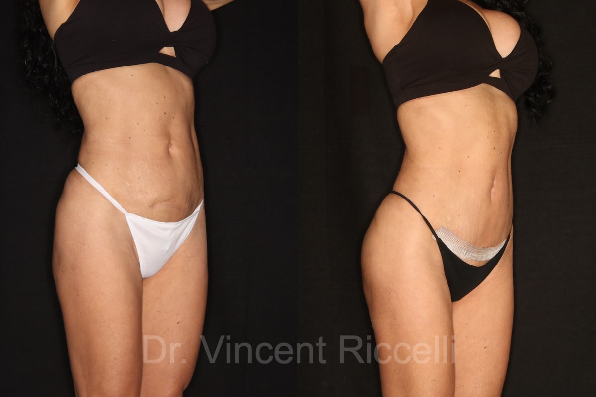 Front oblique view: before and after mini-abdominoplasty, liposuction 360, and gluteal fat grafting with AlloClae by Dr. Vincent Riccelli.